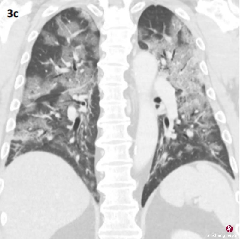◤全球大流行◢病患肺部惊现“碎石路”