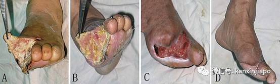 新加坡糖尿病不截肢，国大医院请蛆虫帮忙