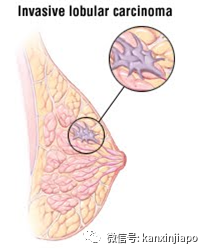新加坡医院180份乳癌报告全错，多人已接受不必要的治疗
