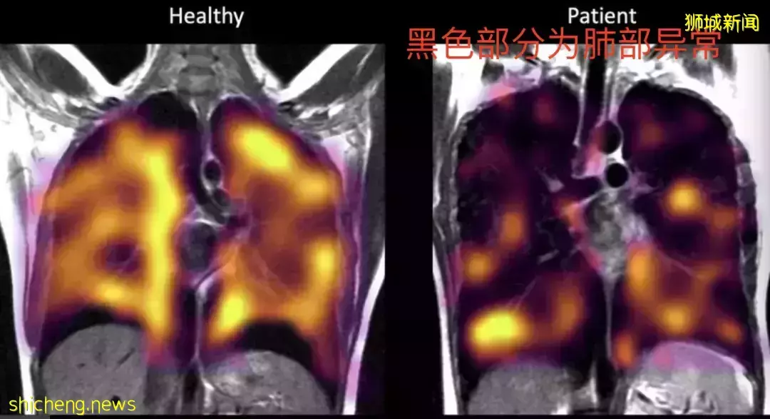 新加坡病例神秘减半，原因在这！57国发现"奥妹"，死亡患者肺部高清照片首曝光