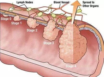 害死黑豹的大腸癌，居然是新加坡男性的頭號癌症