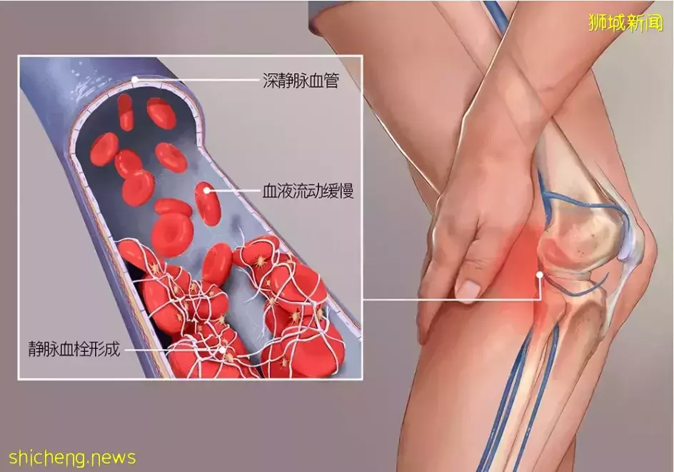 确诊后6个月内患血栓风险高，轻症患者也不例外